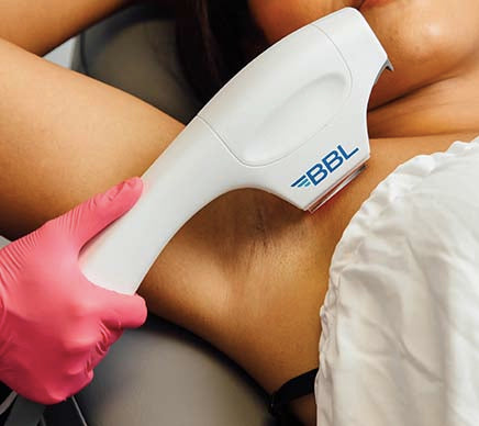 Forever Bare Hair Removal Series of 6